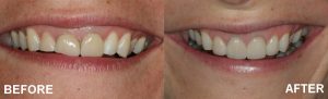 before and after using veneers