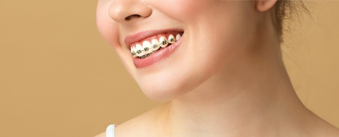 Braces Cheadle