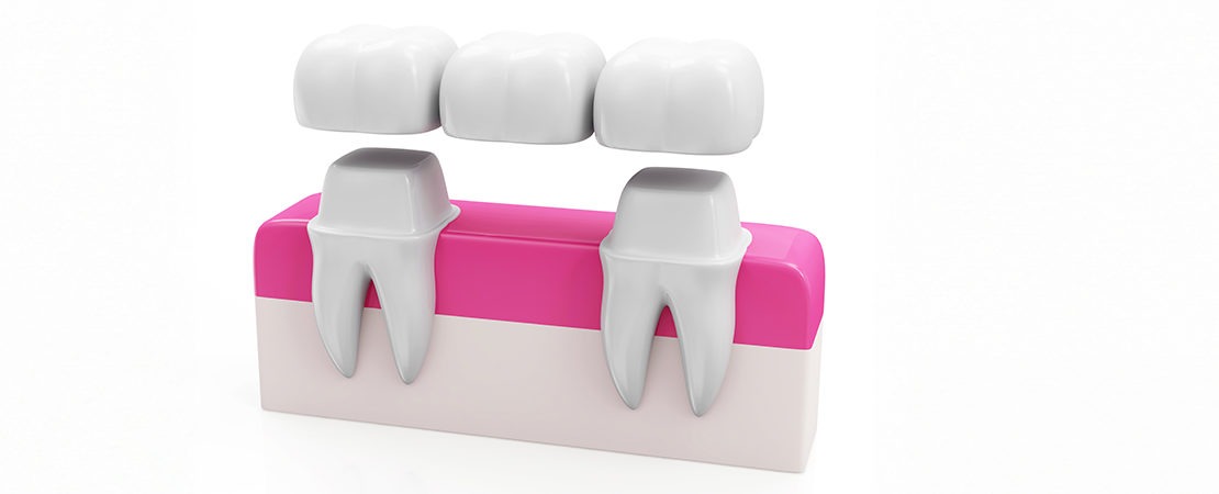 DENTAL BRIDGE IMAGE