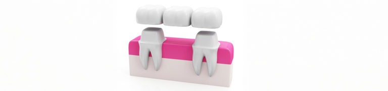 Dental Bridges