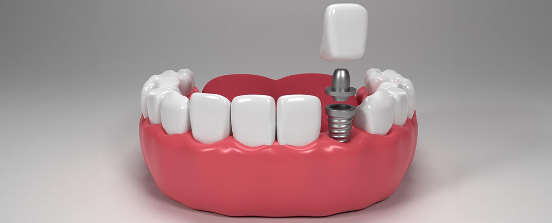 Dental Implant