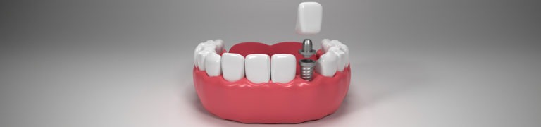 Dental Implant