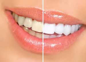 dental bonding before and after