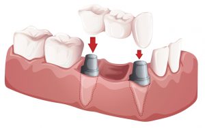 A dental bridges procedure at Cheadle dental practice - cosmetic dentistry