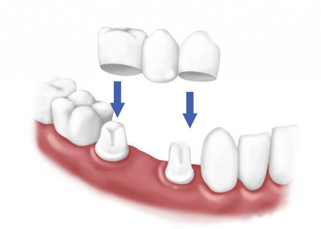 Dental Bridge treatment
