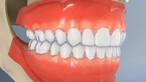 kinds of veneers