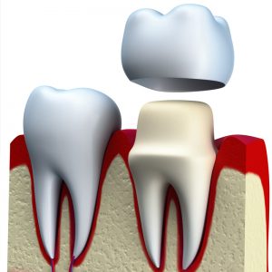 Dental crown made out of porcelain