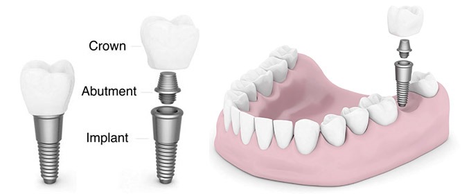 Dental implants treatment cheadle