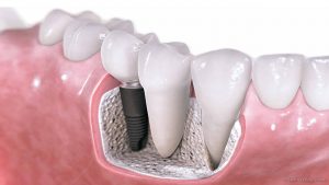 dental implant