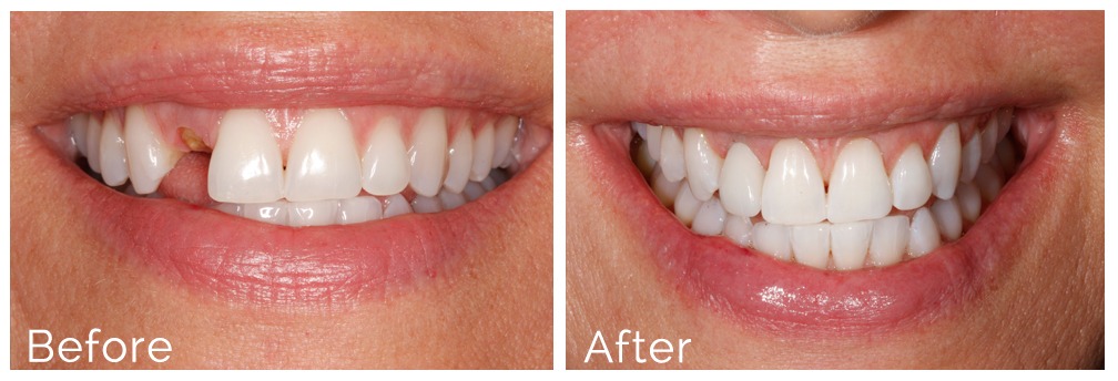 dental implants before after atlanta ga