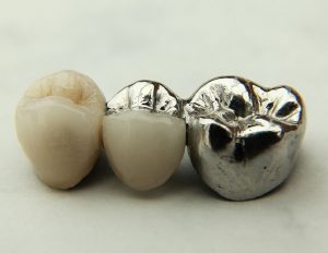dental veneers - veneers vs crowns