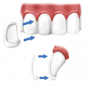 aesthetically pleasing veneers