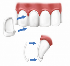 different types of veneers