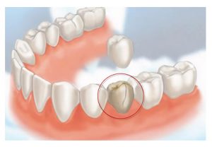 Crown procedure for a broken tooth - cheadle dental practice