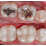 Dental Fillings