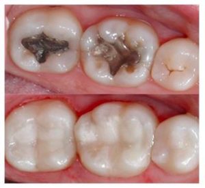 Teeth filling procedure at Cheadle dental practice before and after picture - cosmetic dentistry