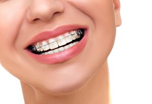 methods to straighten teeth - fixed braces