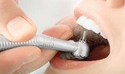Teeth Filling