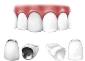 Dental crown made out of metal