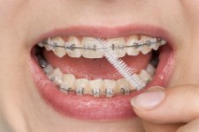 braces