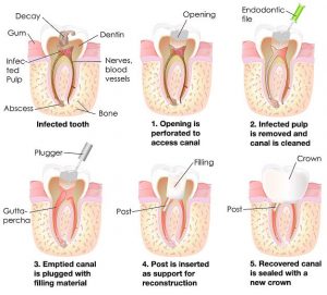 root canals treatment gatley