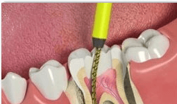 root canals