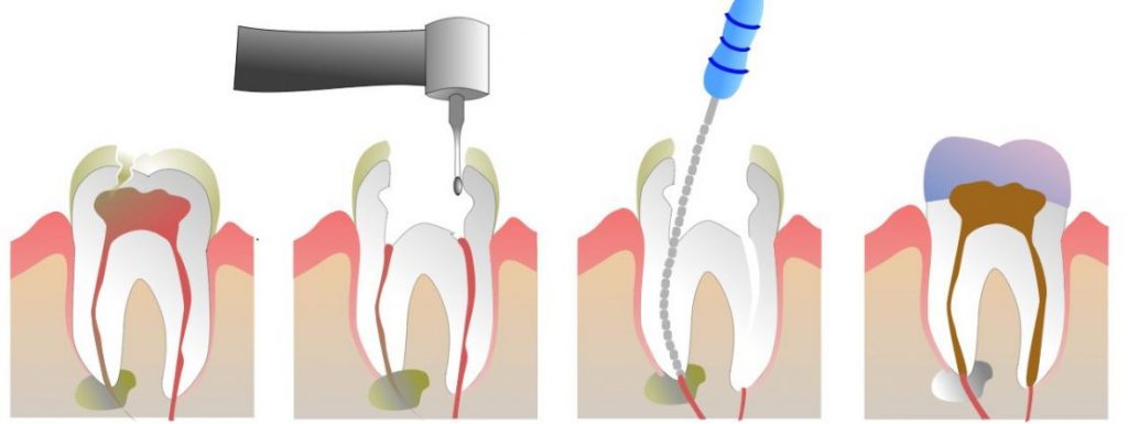root canal treatment cheadle
