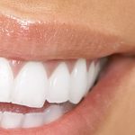 teeth whitening in stockport