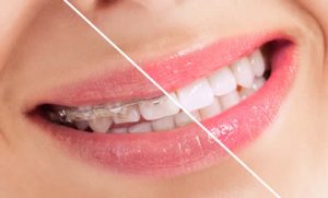 Teeth straightening at Cheadle dental practice - Gatley dentists