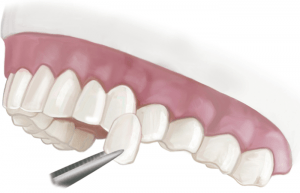 Porcelain veneers