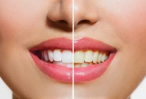 Cosmetic dental treatment - cosmetic dentistry