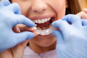methods to straighten teeth - removable braces