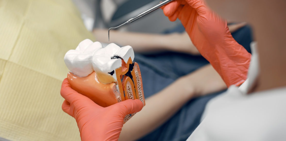 ROOT CANAL