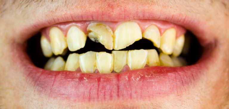 close up image of broken tooth