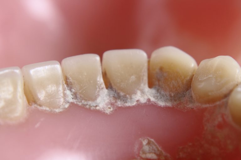 Early signs of tooth decay