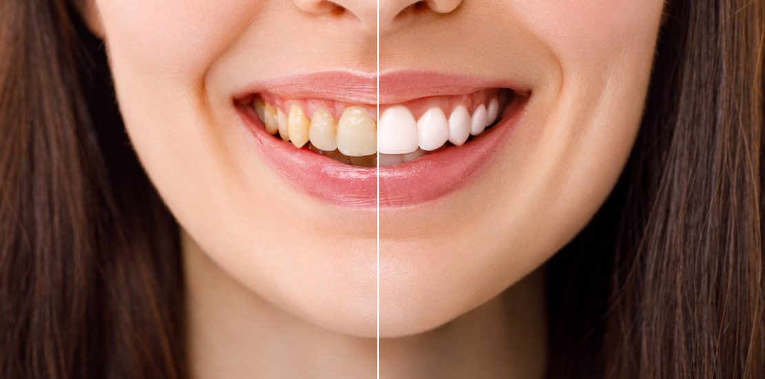 teeth whitening cost in UK - cheadle dentists