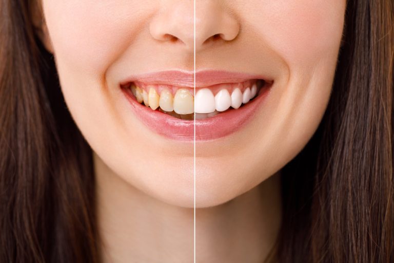 teeth whitening cost in UK - cheadle dentists