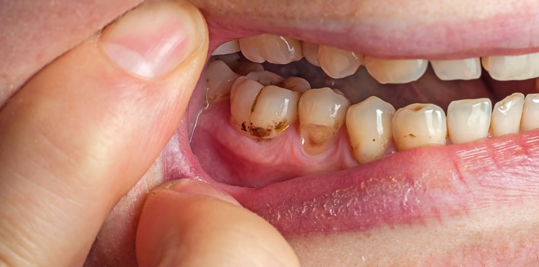 discoloured teeth - teeth whitening treatment