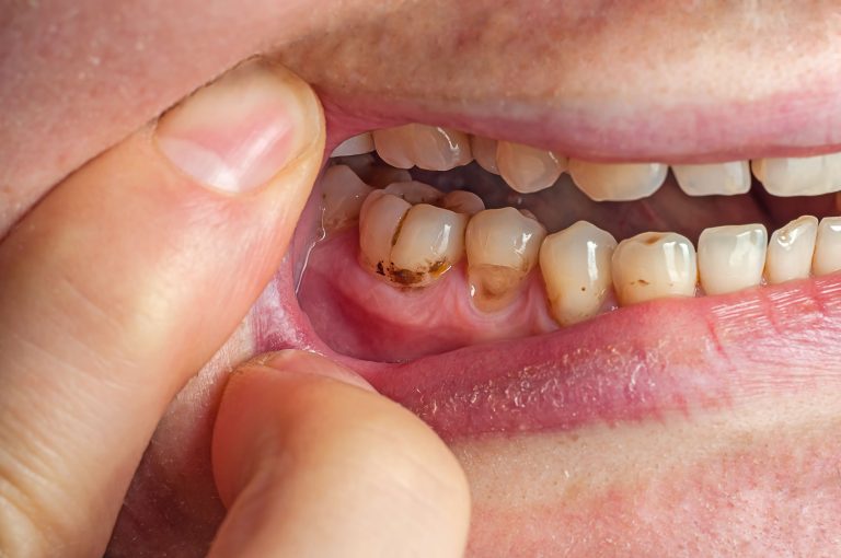 discoloured teeth - teeth whitening treatment