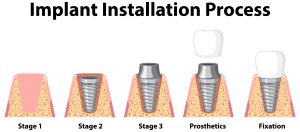 Exploring Procedures for Perfect Tooth Implants 5 implant installation process