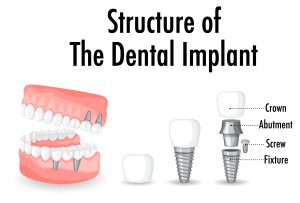 Exploring Procedures for Perfect Tooth Implants 4 structure of the dental implant