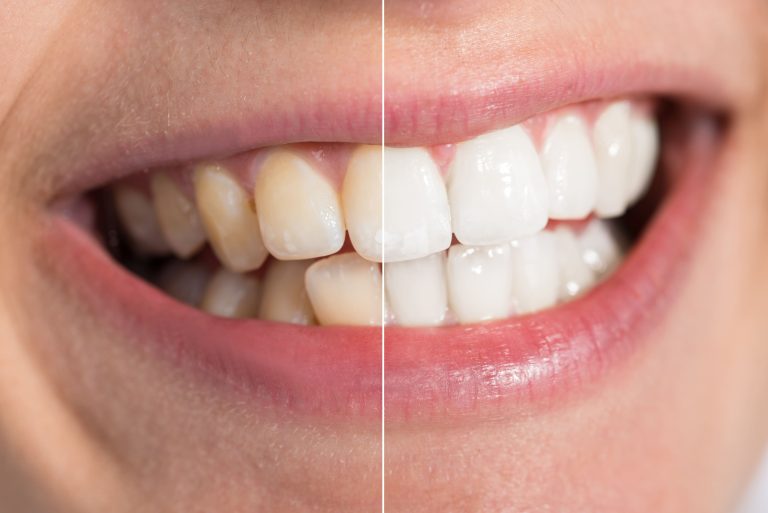Teeth Whitening procedure